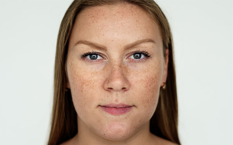 Dark Spots and Pigmentation